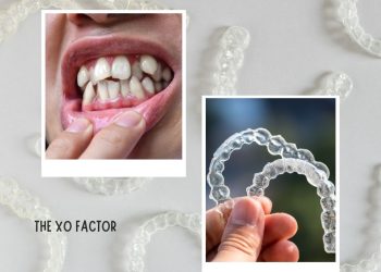 Treating Misaligned Teeth With Invisible Braces