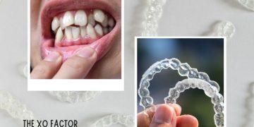 Treating Misaligned Teeth With Invisible Braces