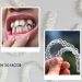 Treating Misaligned Teeth With Invisible Braces