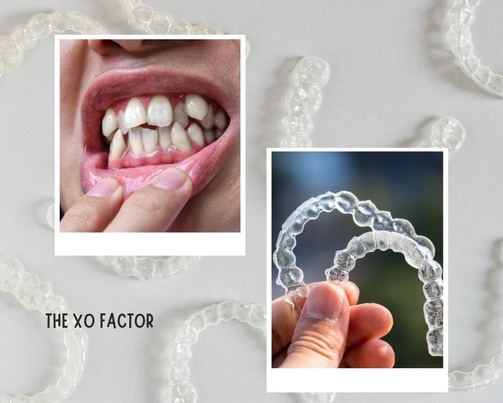 Treating Misaligned Teeth With Invisible Braces