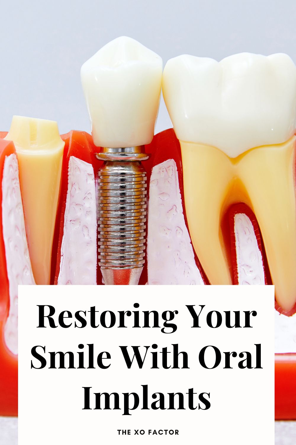 Restoring Your Smile With Oral Implants