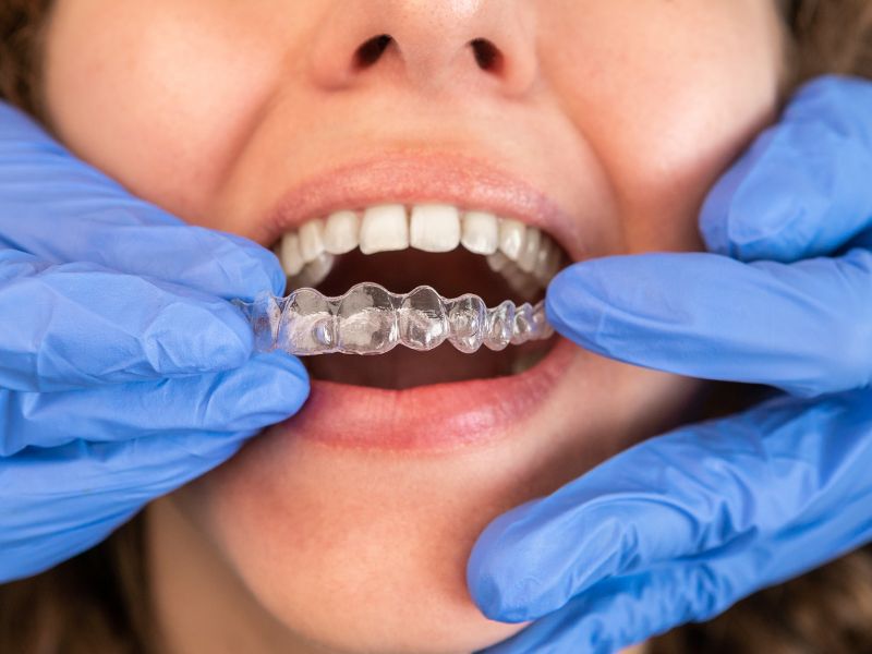Giving Patients Straight Teeth With Invisalign