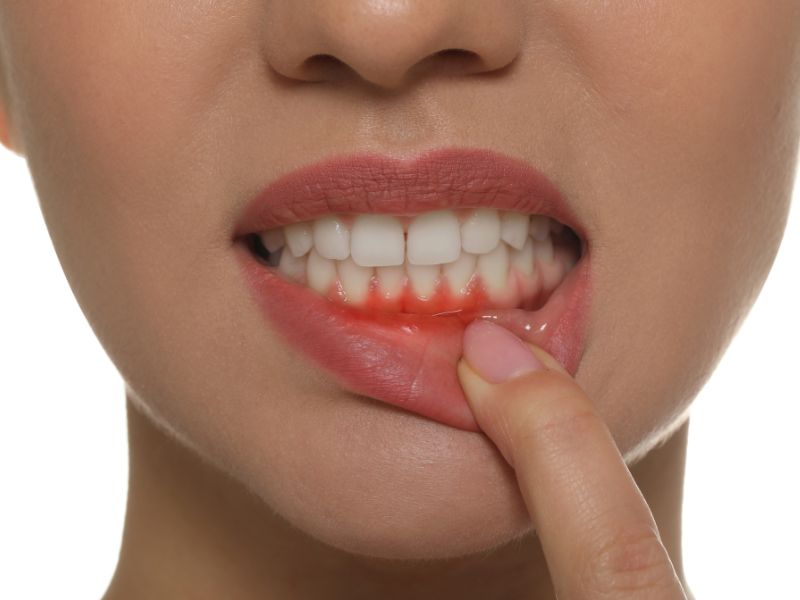 Preventing Periodontal Disease With Your Dentist