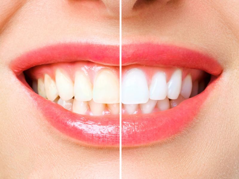 Effective Teeth Whitening Macleod That Is Suitable For You