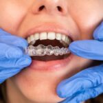 The Benefits Of Invisalign