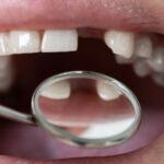 Replacing Missing Teeth After Gum Disease With Dental Implants Ryde