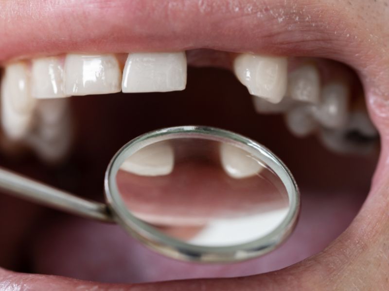 Replacing Missing Teeth After Gum Disease With Dental Implants Ryde