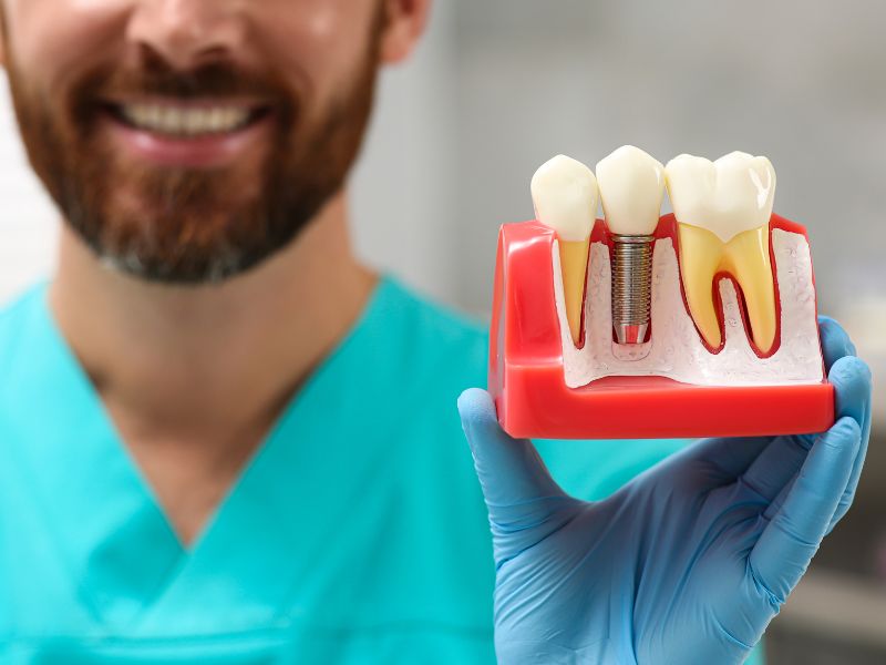 Dental Implants: A Comprehensive History From Ancient Times To Modern Techniques