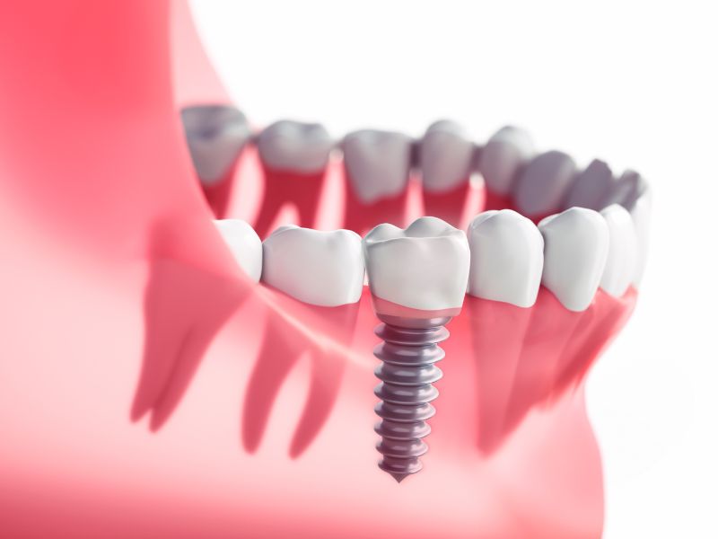 Tooth Replacement With A Dental Implant