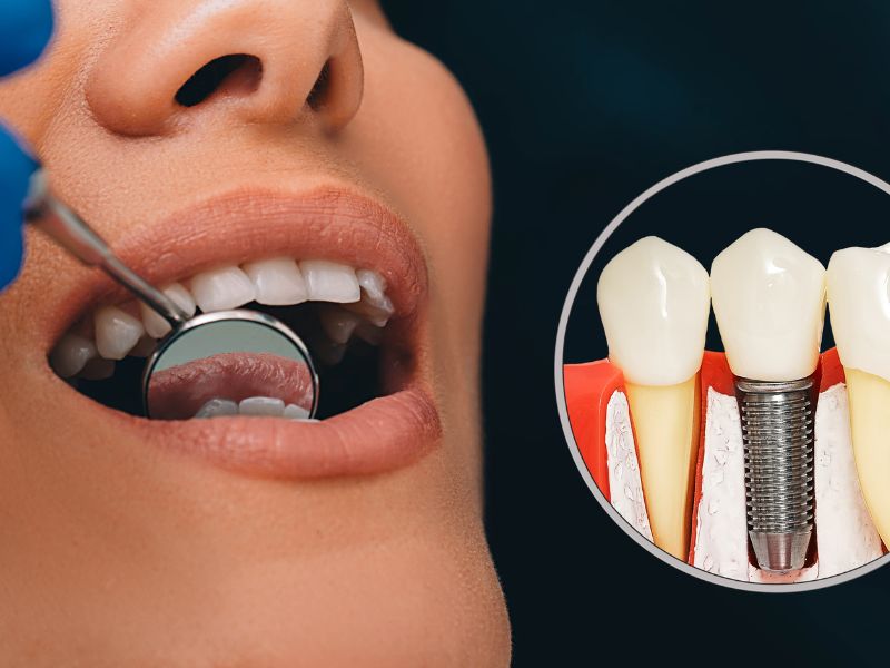 Dental Implant Maintenance: Best Practices For Long-Term Oral Health