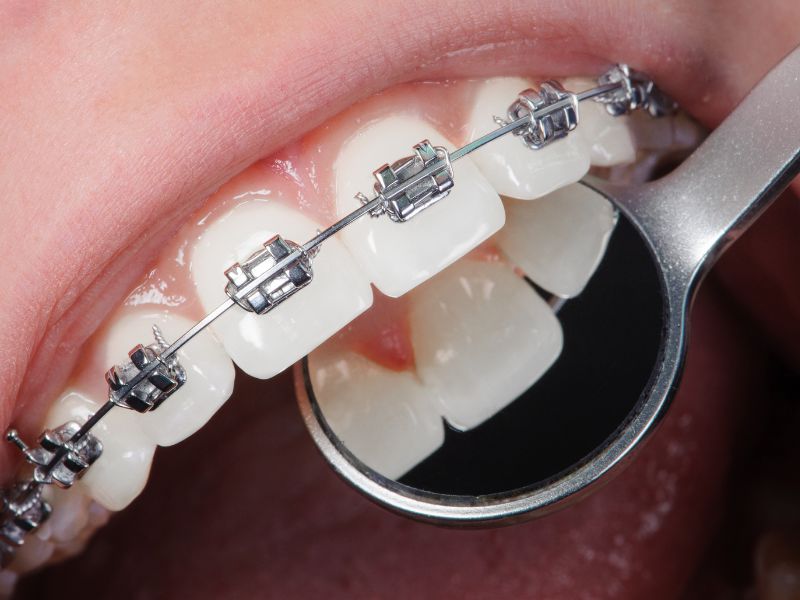 Why teeth straightening treatments are necessary
