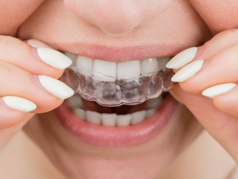 Teeth Straightening For Adults With Invisible Braces