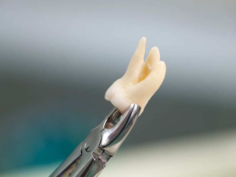Five Signs You Need A Wisdom Tooth Extraction