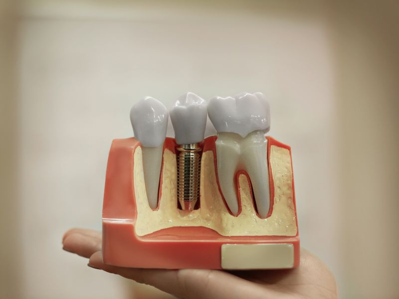 What's Been Missing In Your Life? Dental Implants!