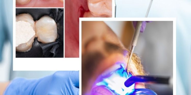 What Is Composite Bonding?  