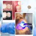 What Is Composite Bonding?  