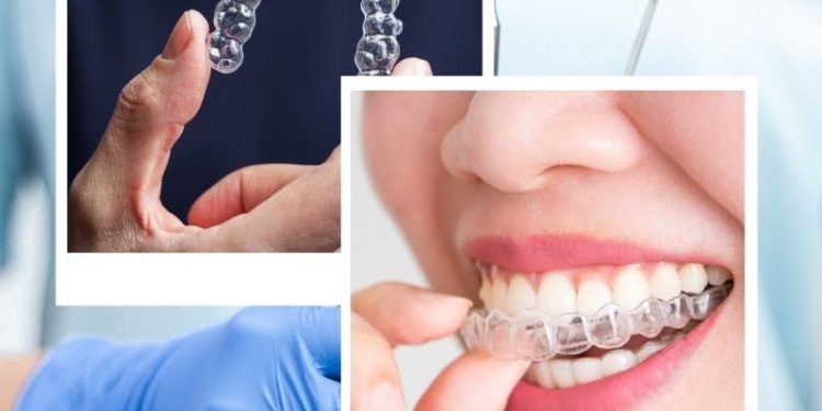 Invisalign Discreet Dental Treatment